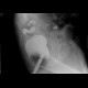 Post-inflammatory stenosis of the sigmoid colon: RF - Fluoroscopy